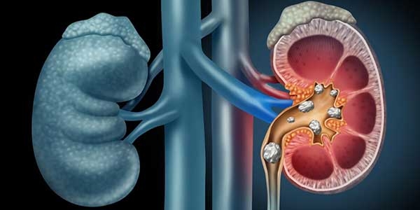 ارتباط بین مصرف پروتئین ها و سنگ کلیه