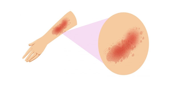 معرفی پماد برای از بین بردن لک سوختگی