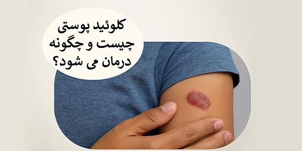 کلوئید پوستی چیست و چگونه درمان می‌شود؟
