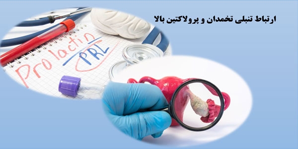 ارتباط تنبلی تخمدان و پرولاکتین بالا