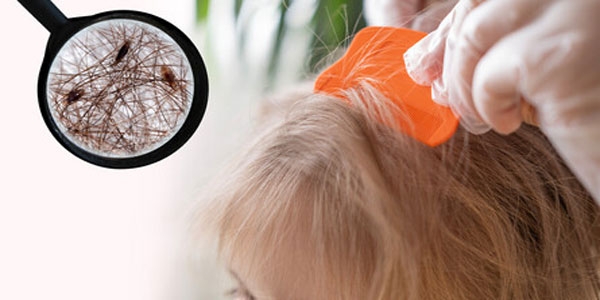 چگونه شپش سر را ریشه کن کنیم؟