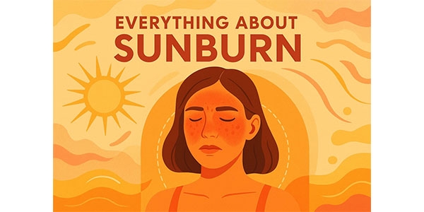 همه چیز در مورد آفتاب سوختگی