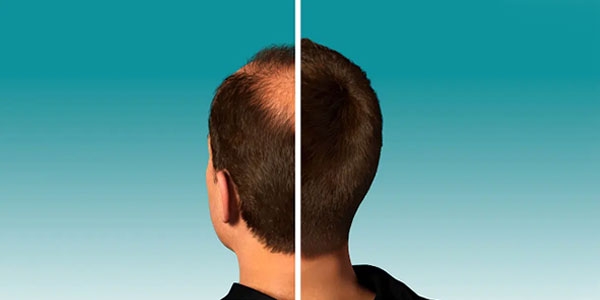 همه چیز در مورد ریزش مو بعد از کاشت