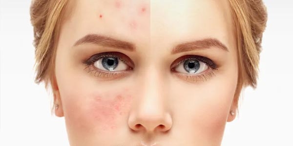 بهبود آکنه با ژل گیاهی آکدین