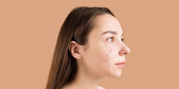 آلفا آربوتین چیست و چه خواصی دارد؟