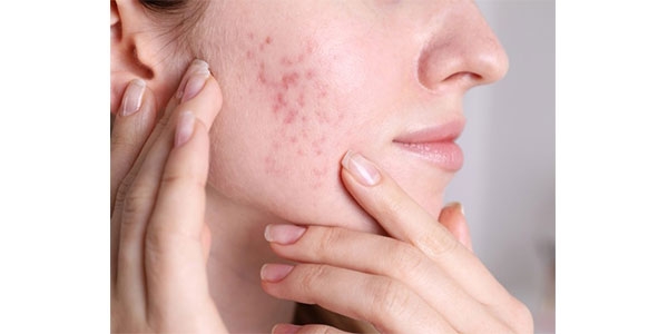 بهترین ضد لک برای جای جوش