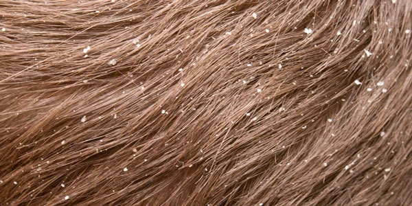 بهترین شامپو ضد شوره ایرانی