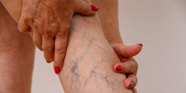 رپورتاژ- پیشگیری و درمان واریس و همورویید