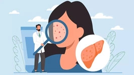 علائم کبد چرب در چهره