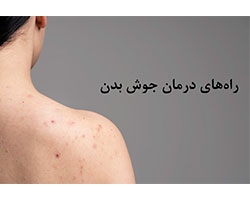 راه های درمان جوش بدن
