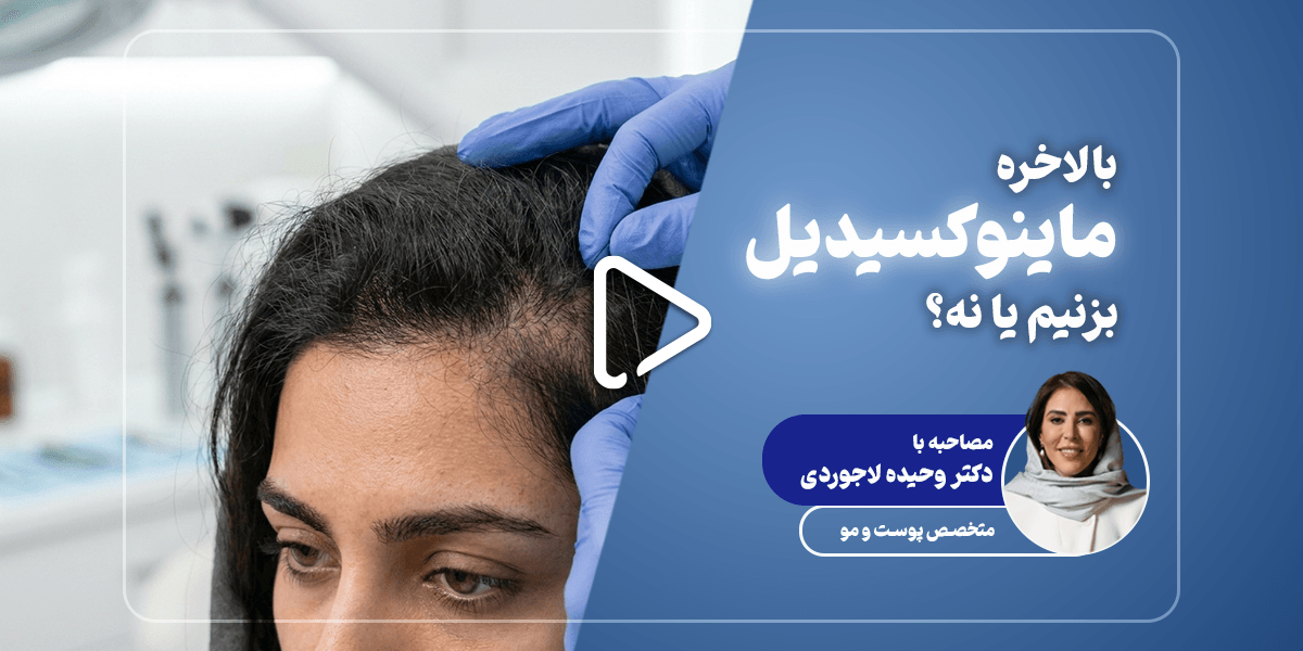 راهنمای جامع ماینوکسیدیل؛ از سازوکار علمی تا ناگفته‌های درمان ریزش مو