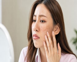 بهترین کرم برای لک بارداری