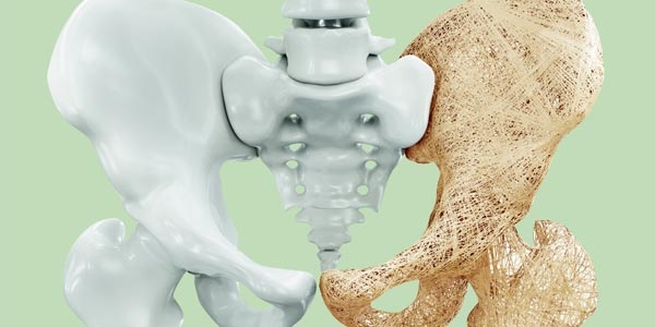 رپورتاژ- استئوپروزیس (پوکی استخوان) و نقش عناصر مختلف