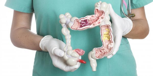 علائم و دلایل سرطان روده