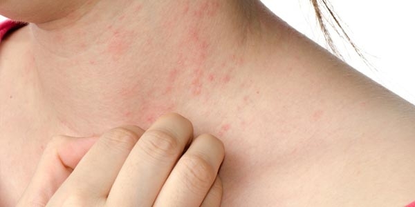 رپورتاژ- EPA و کنترل اگزما