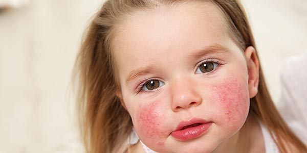 آلرژی غذایی در کودکان