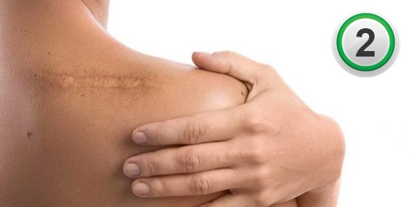 اسکار و راه های درمان آن (قسمت دوم)