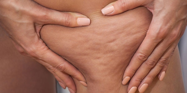 درباره سلولیت، تشکیل و درمان آن بیشتر بدانید