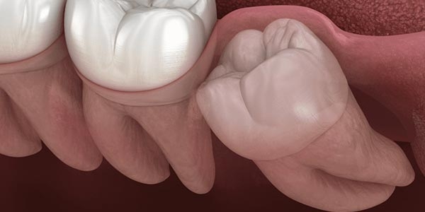 همه چیز درباره دندان عقل