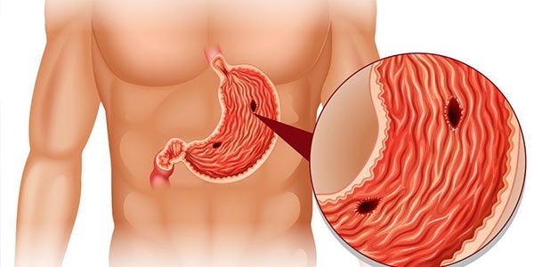 زخم معده، علائم و درمان های آن