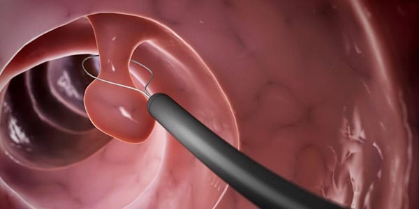 انواع پولیپ را بشناسید