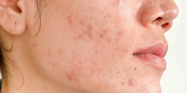 انواع ترکیبات ضد لک