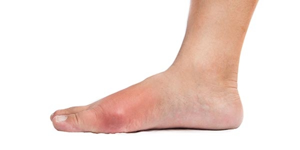 نقرس و باید ها و نباید های تغذیه ای