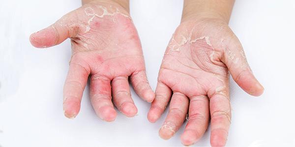 علت پوسته پوسته شدن انگشتان دست و راه های درمان آن